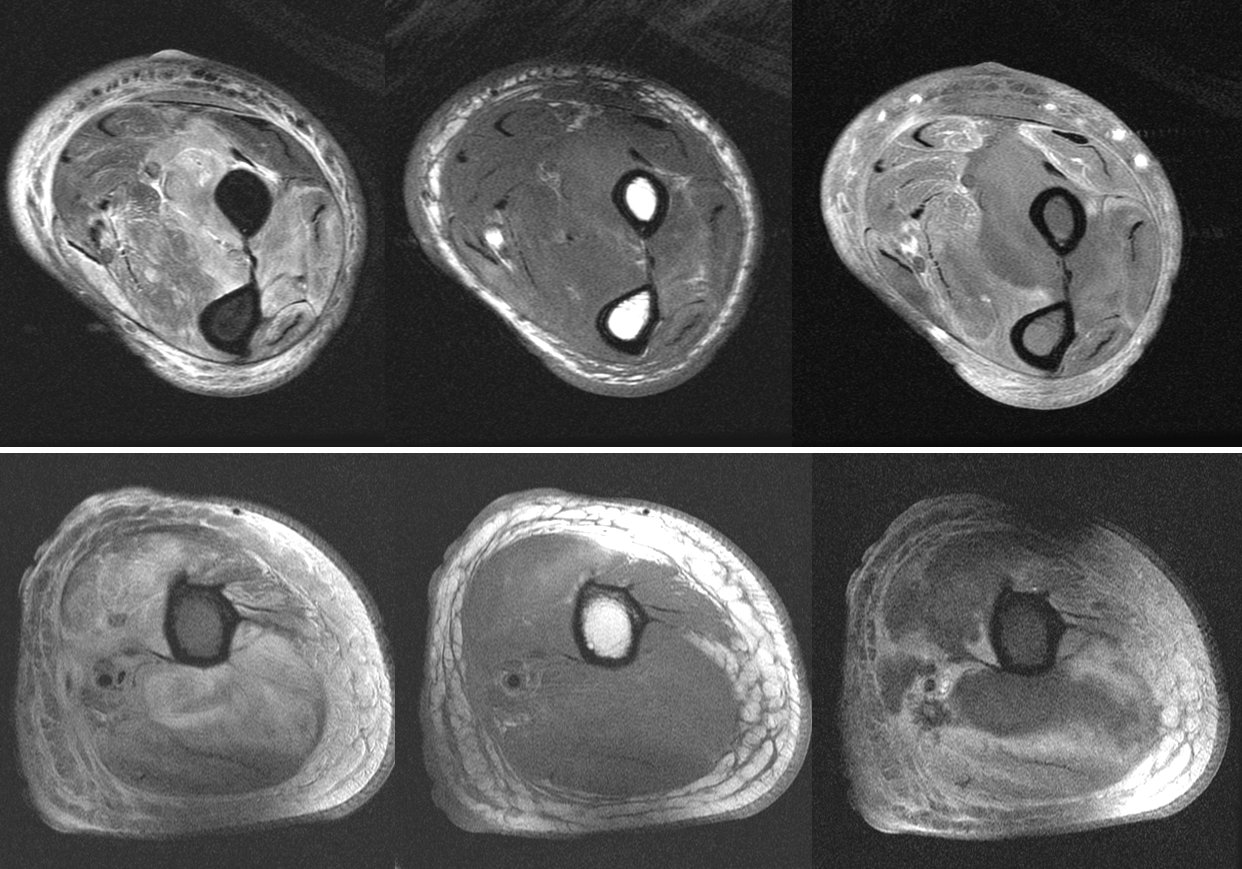 Figure 4 for case Diabetic myonecrosis with cellulitis